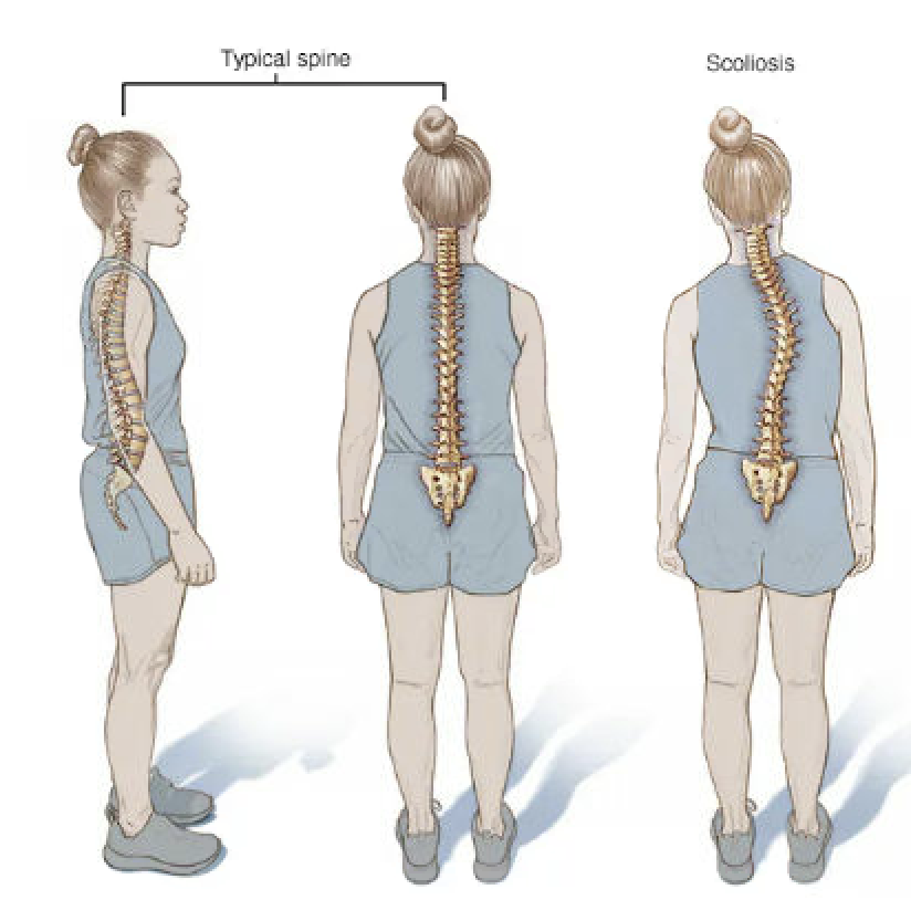 Scoliosis - Dr. Micheal Raad